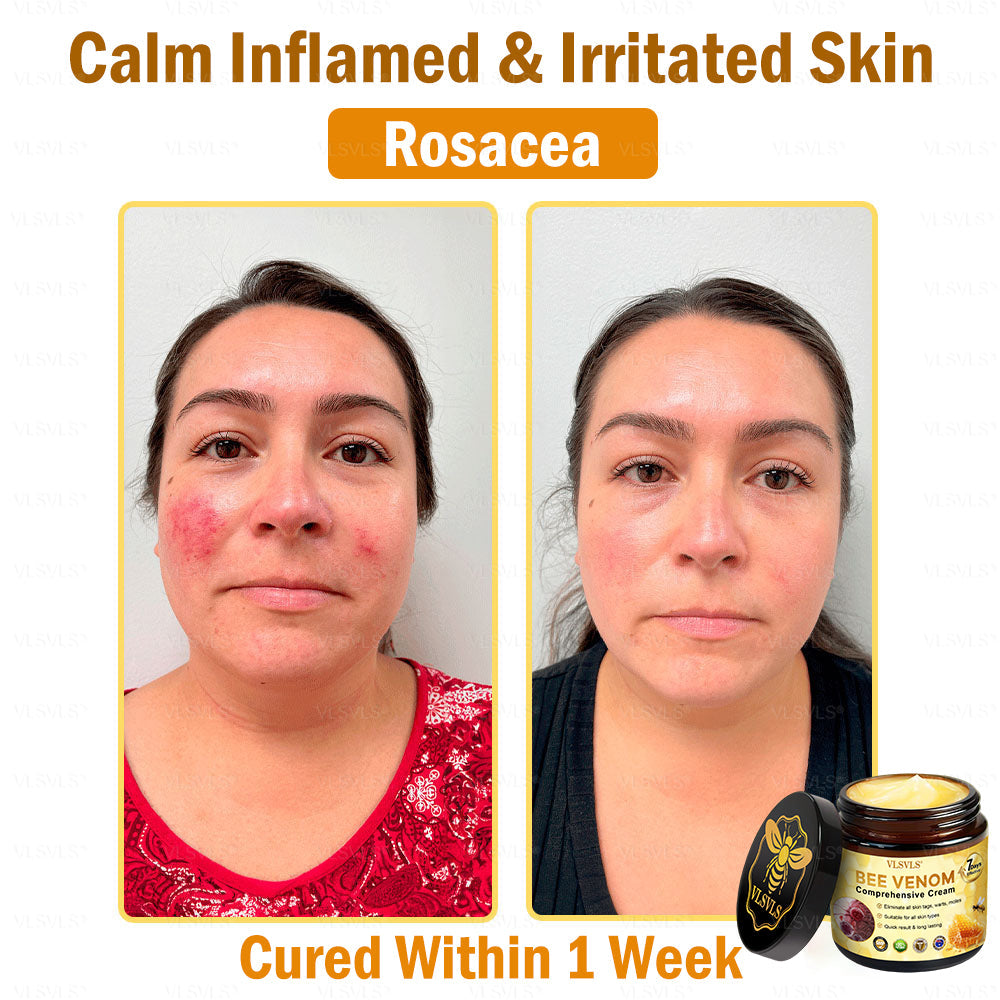 VLSVLS® Bee Venom Comprehensive Cream 🇭🇲🇭🇲(Suitable for all ages)